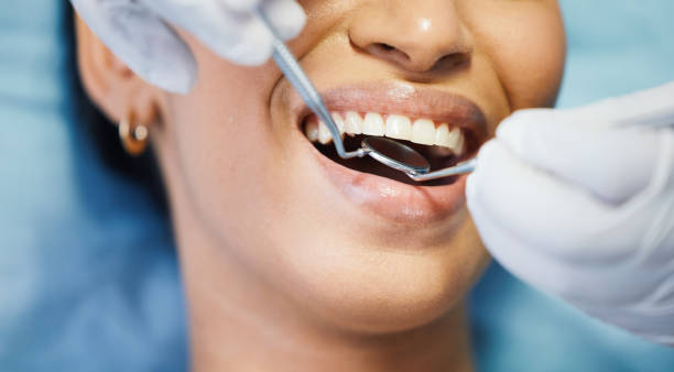 Best Emergency Wisdom Tooth Extraction in Oneonta, NY
