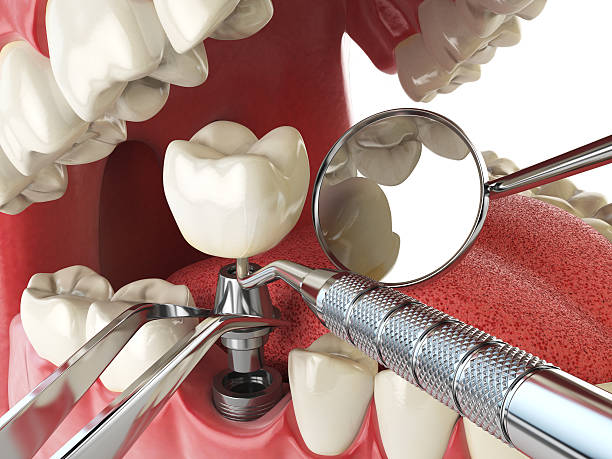 Best Lost Filling or Crown Replacement in Oneonta, NY