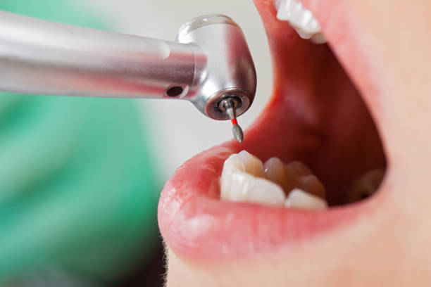 Best Knocked-Out Tooth (Avulsed Tooth) Treatment in Oneonta, NY